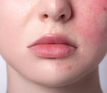 Wszystkie twarze rumienia – gdy skóra mówi więcej, niż myślimy